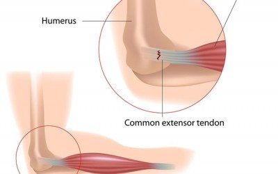 11 Signs You Have Tennis Elbow and What to Do About It