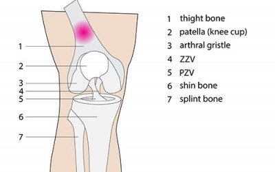 The right way to treat tendonitis