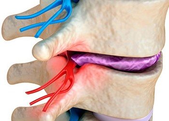 Back pain? No such thing as a slipped disc