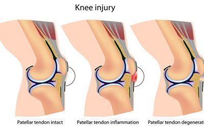 Jumper’s Knee – What Is It and How Can I Fix It?