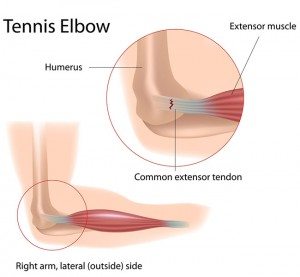 Tennis elbow graphic showing pain points