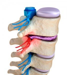bulging disc in spine