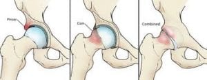 Hip pain picture