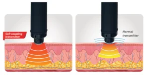 Shockwave therapy has deep penetration into the tissues