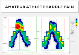 Before and after Gebiomized saddle pressure maps showing reduced front saddle pressure and improved stability following a physiotherapy-led bikefit at Star Physio