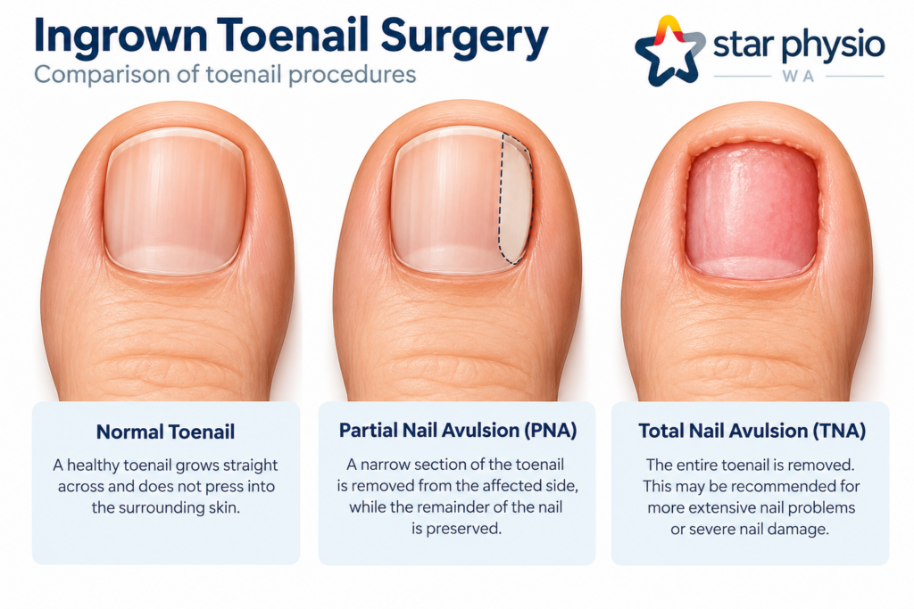 Diagram comparing partial and total nail avulsion procedures for ingrown toenail surgery